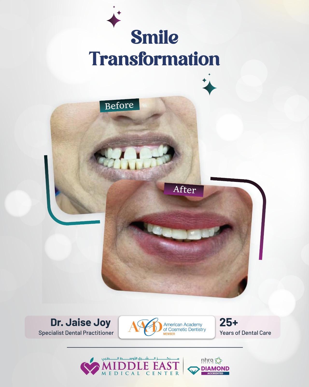 Dental aesthetic enhancement